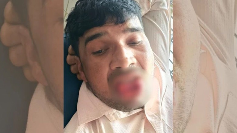 কামড়ে প্রেমিকের জিহ্বা ছিঁড়ে ফেললেন তরুণী